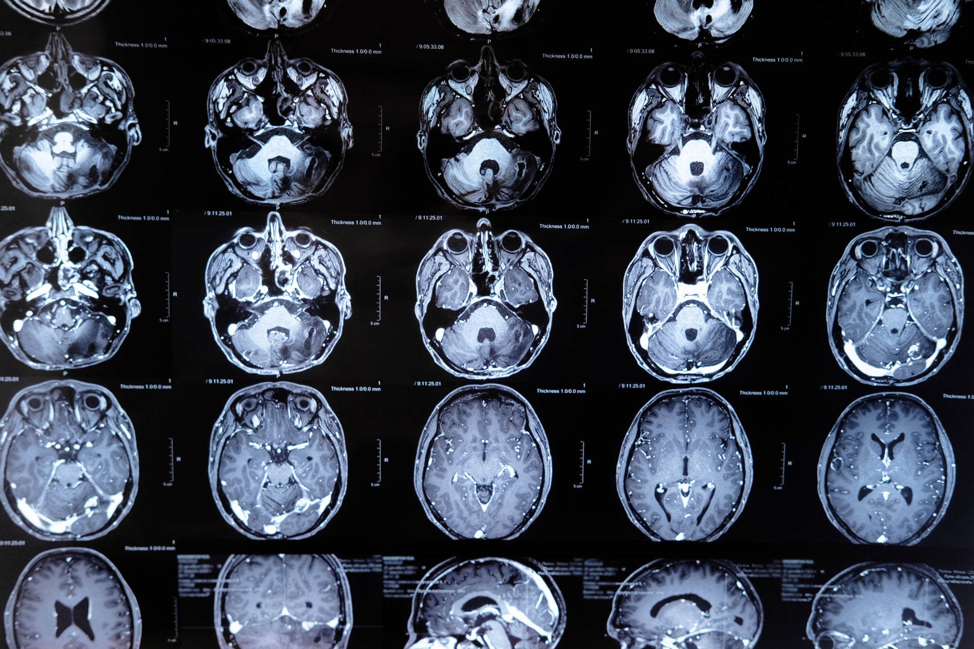 Amelioration of Alzheimer's-Type Pathological Impairments with Semax
