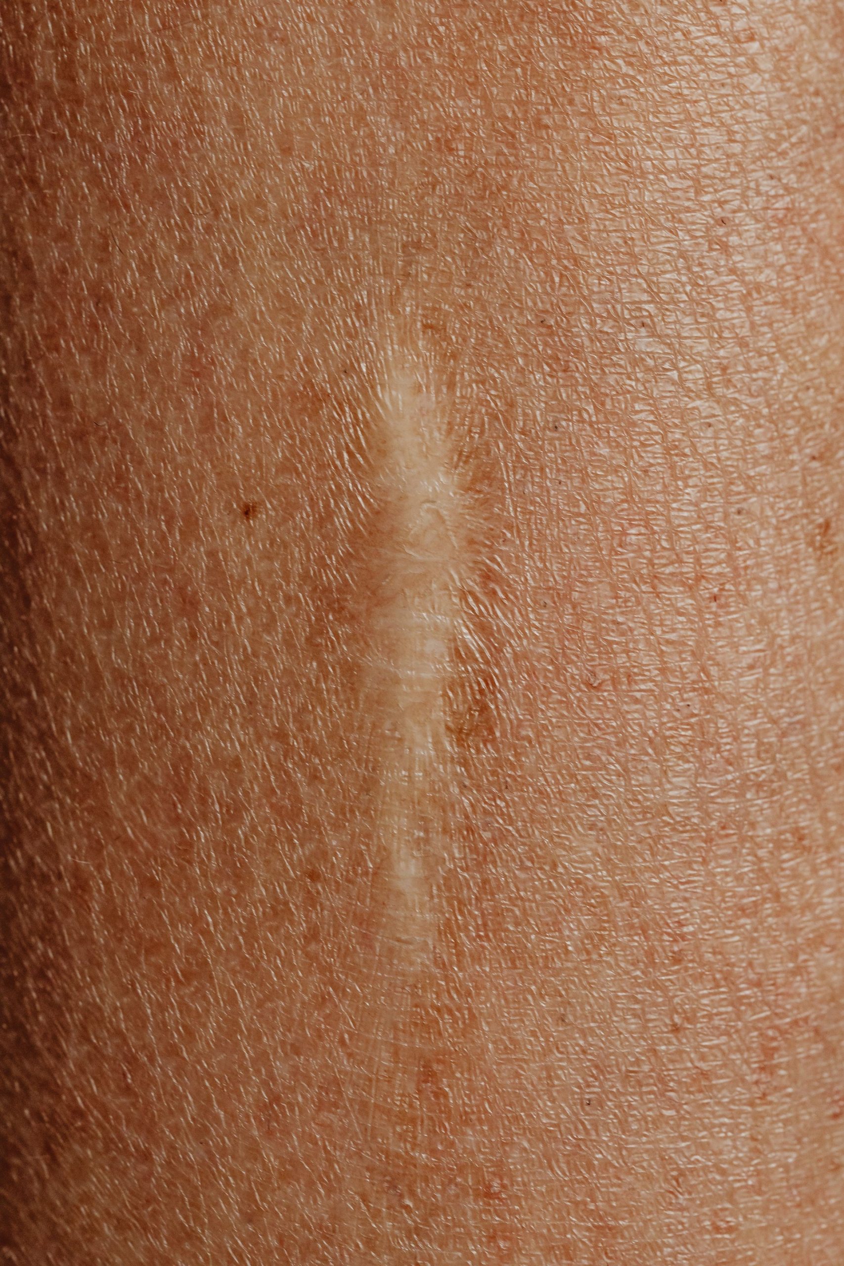 The Effect of TB-500 Fragment (17-23) on Isolation of the Core Migration and Wound-Healing Sequence