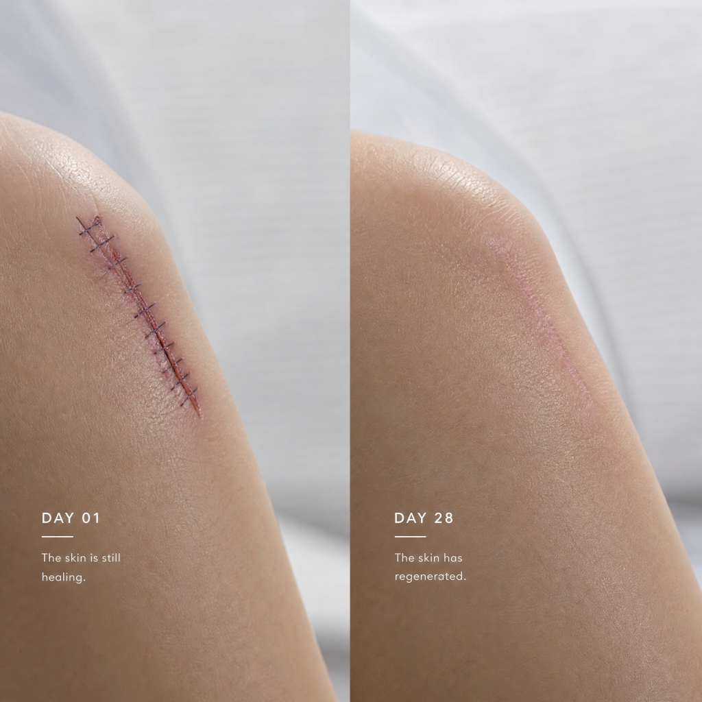 The Effect of KPV on Acceleration of Dermal Wound Healing and Scar Minimization